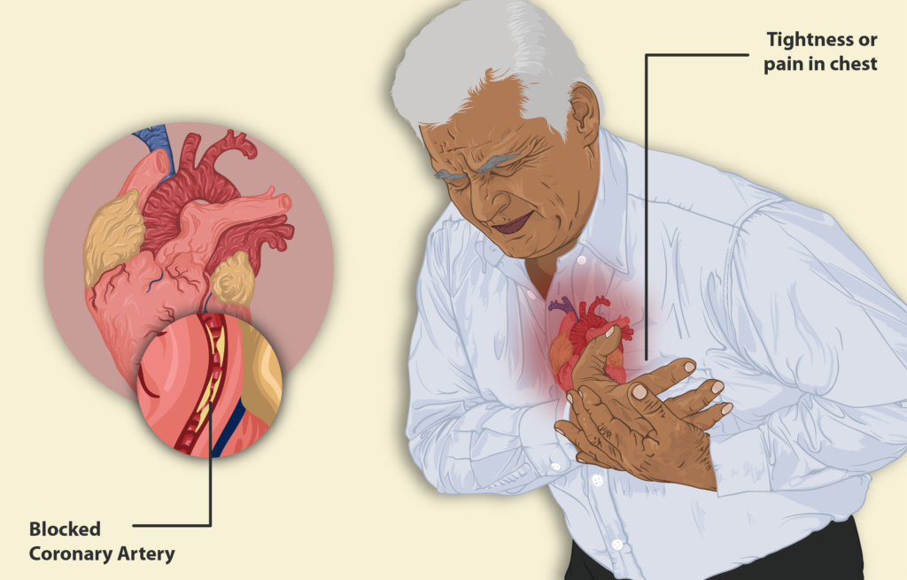 Angina pectoris Heart Pain