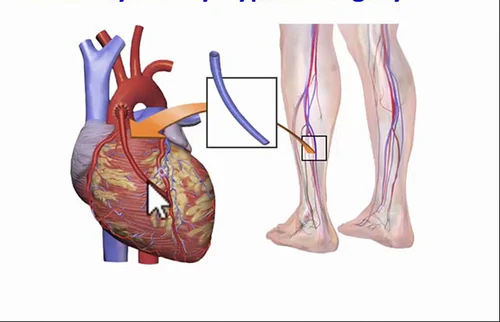 Angina pectoris Heart Pain