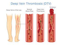 Deep vein thrombosis 