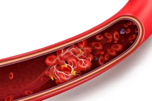 Difference Between Thrombus and Atheroma