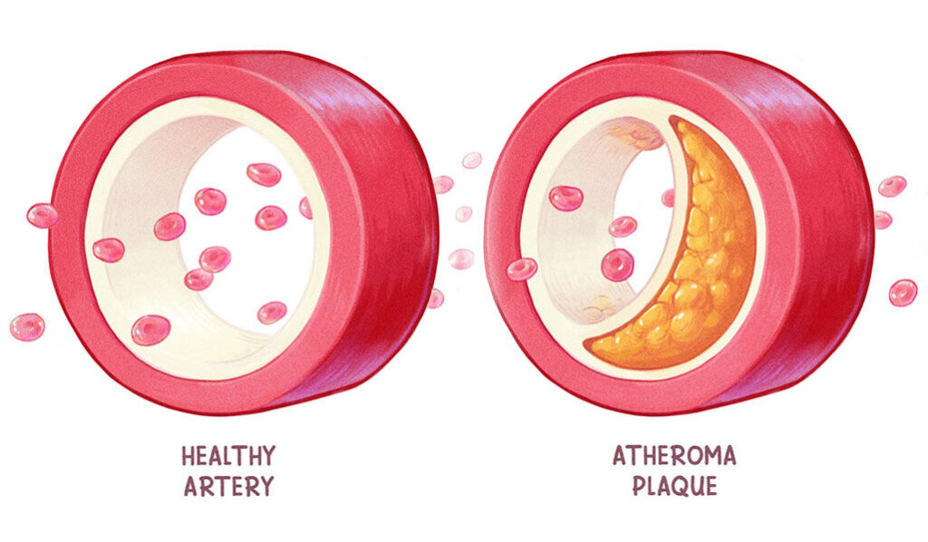 Effects of Atheroma