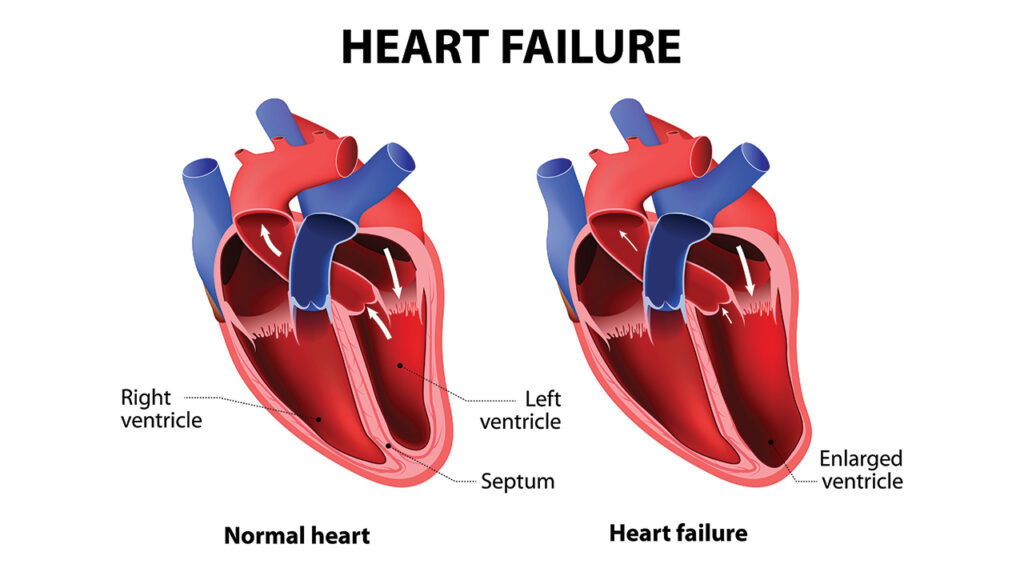 Symptoms of Heart Failure