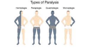 Paralysis or Stroke Specialist Doctors